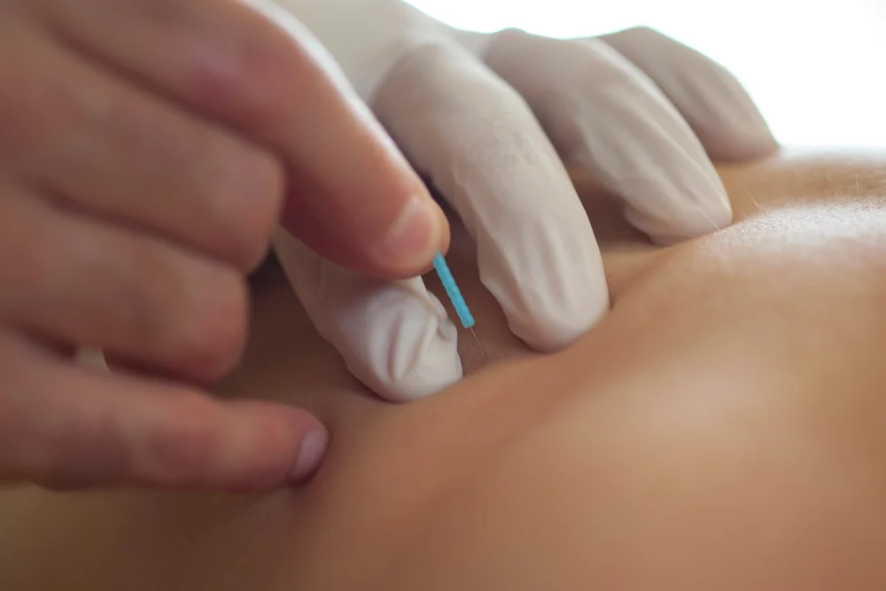 Dry Needling Behandlung bei muskulären Triggerpunkten